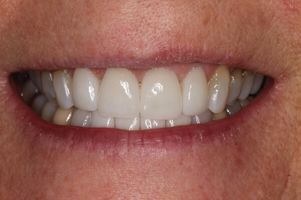 Dr Perpich and Aurora Dental Designs Inc lab Upper anterior veneers.
