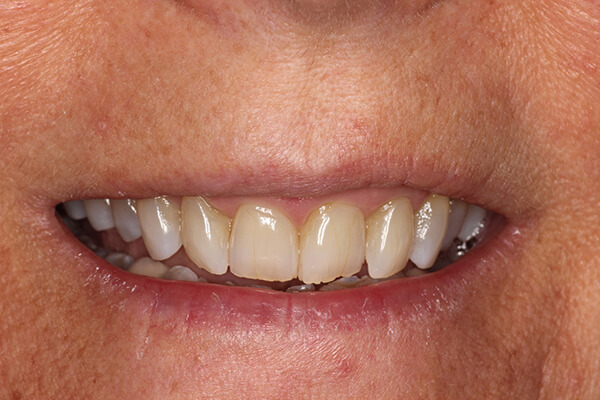Dr Perpich and Aurora Dental Designs Inc lab Upper anterior veneers