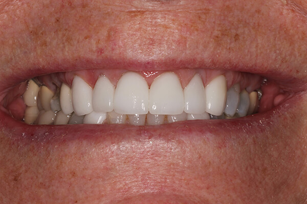 Veneer case done by Dr Perpich and veneers created at Aurora Dental designs Inc. lab.