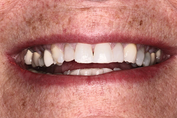 Veneer case done by Dr Perpich and veneers created at Aurora Dental designs Inc. lab