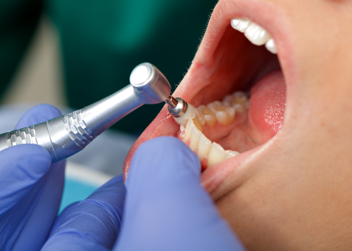 Person receiving a routine cleaning at a dentist’s office, removing tartar and plaque